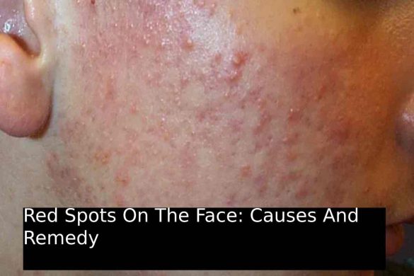 Red Spots On The Face: Causes And Remedy