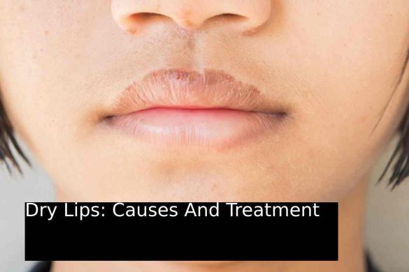 Dry Lips_ Causes And Treatment
