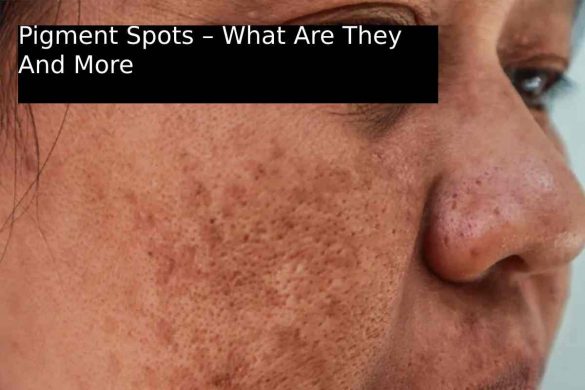 Pigment Spots – What Are They And More