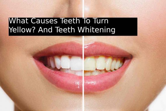 What Causes Teeth To Turn Yellow_ And Teeth Whitening Treatment